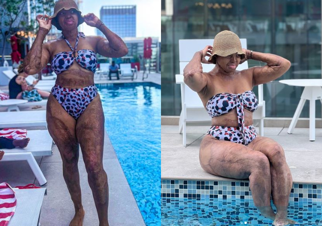 Plane Crash Survivor, Kechi Okwuchi shares stunning photos of herself in a bikini